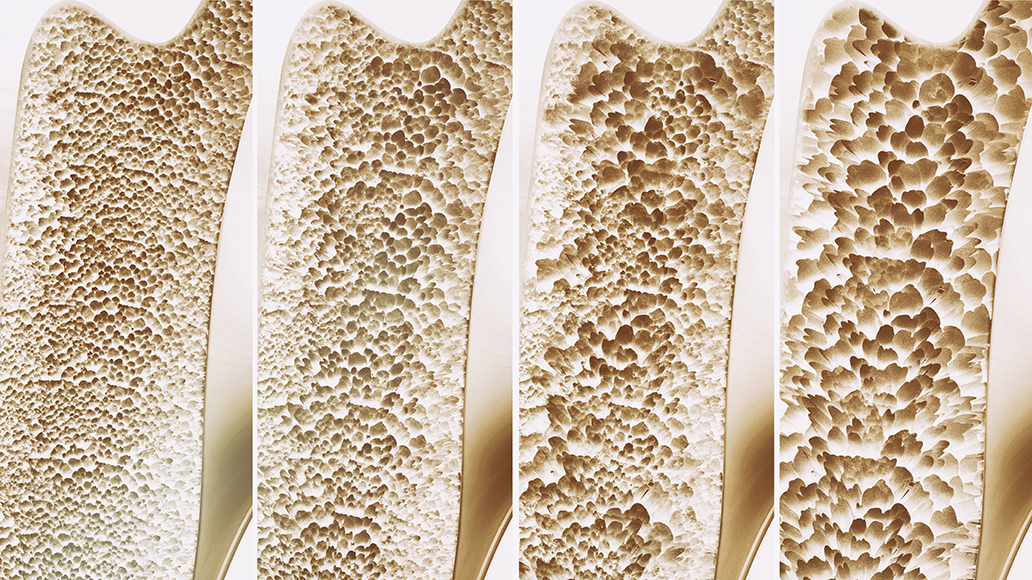 Osteoporose, Knochendichte, Erklärung